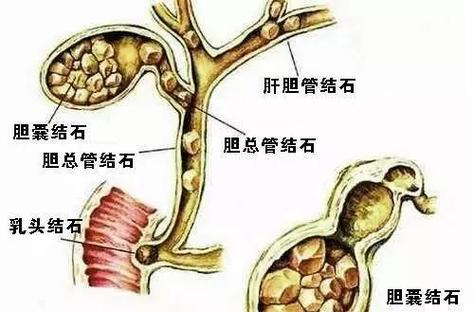 肾结石吃青柠檬还是黄柠檬截图