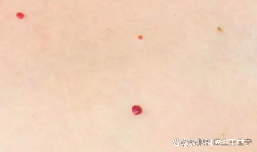 肝病早期小红点图片