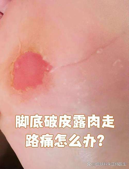 烫伤掉一层皮露肉能用碘伏吗