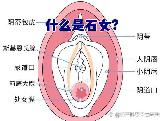 什么是石女