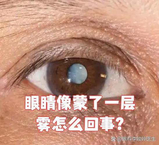 眼睛雾蒙蒙的是什么原因造成的