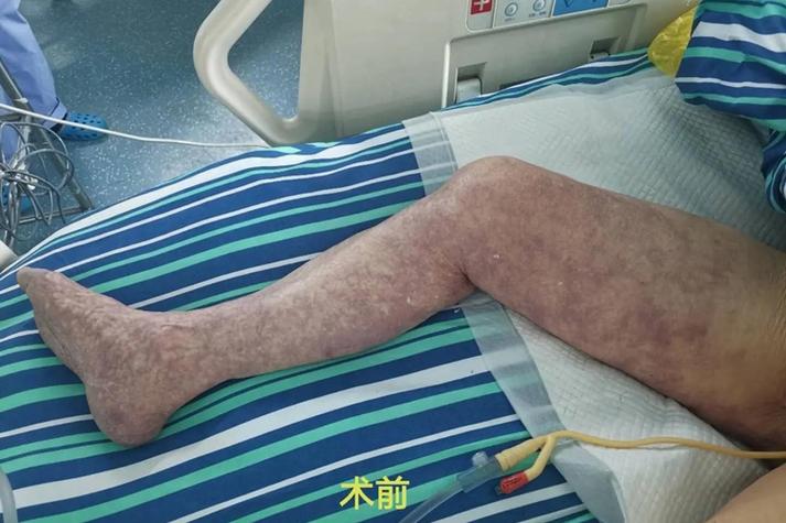 血栓是什么