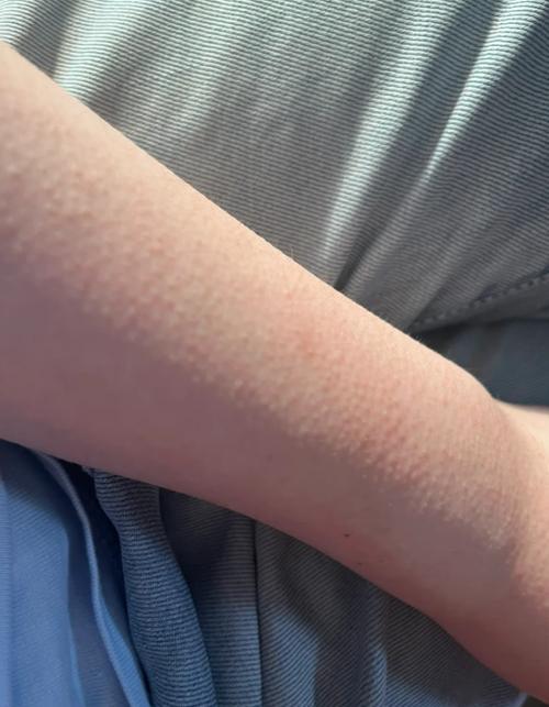 手臂一挠就起一小堆疙瘩还痒