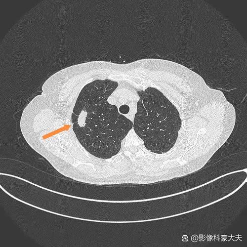 肺结节多少mm正常