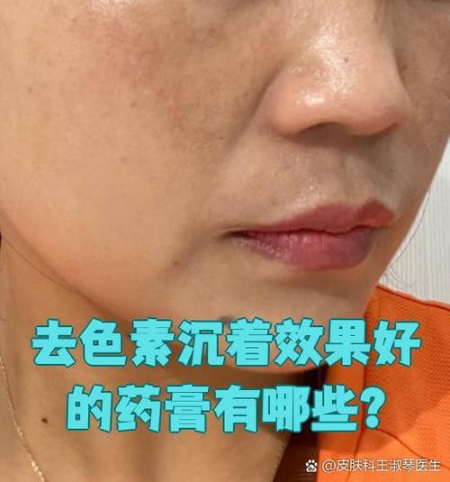 去色素沉着最好的药膏