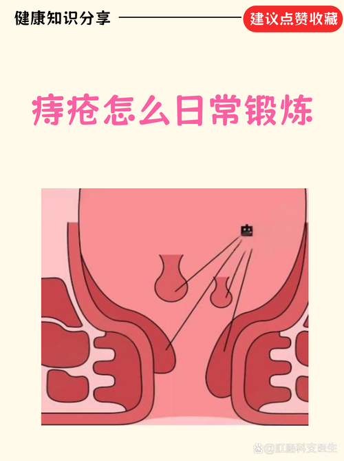 痔疮手术后提肛运动的正确做法