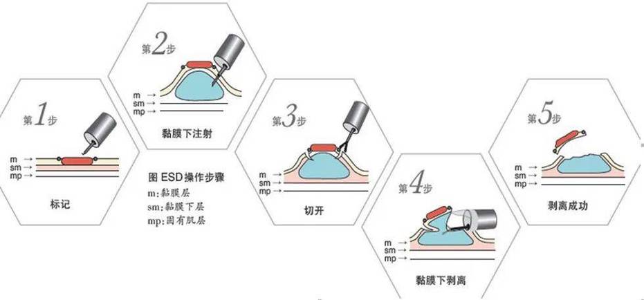 无痕微创水剥离