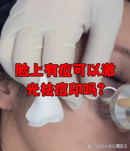 太阳凹陷怎么锻炼缩略图
