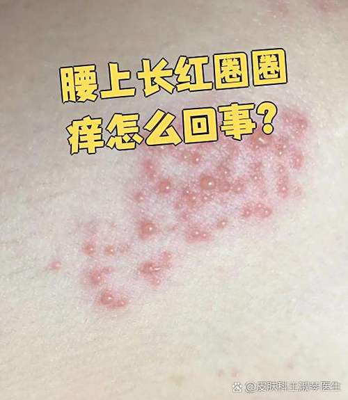 为什么挠腰会感觉痒
