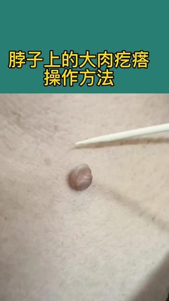 小肉粒最好的去除方法