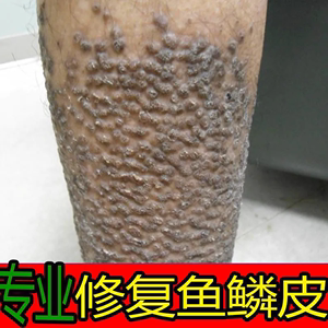 手上长鱼鳞怎么去除掉
