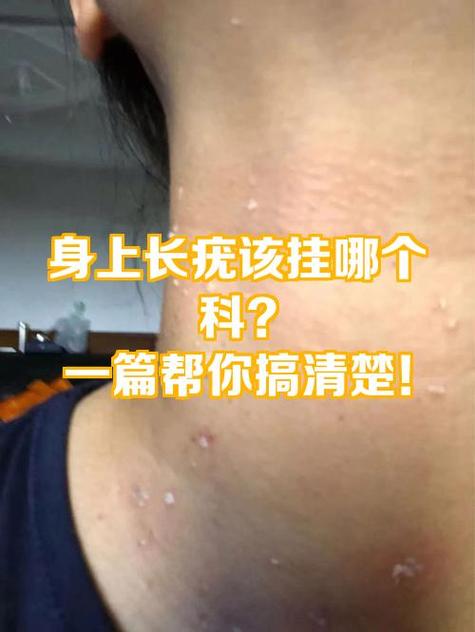 想祛斑去医院挂什么科
