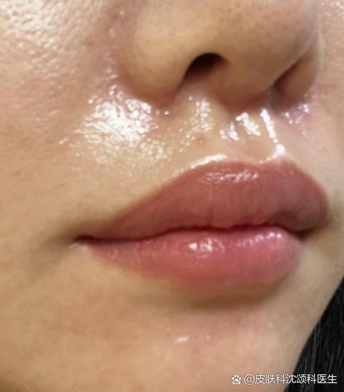 油性皮肤