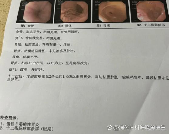 胃上部心窝处堵胀是什么原因