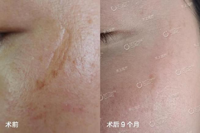 手术后疤痕怎么消除