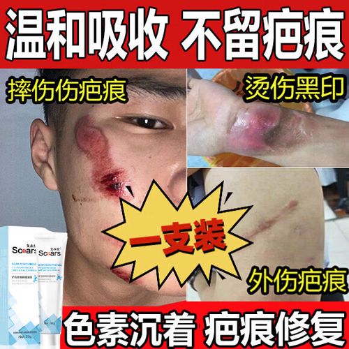 怎么淡化烫伤的黑印
