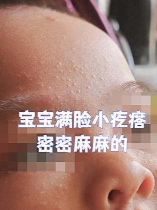 热疹是什么原因造成的