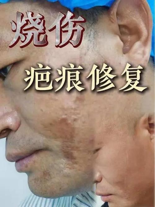 凹陷疤痕怎么修复平整