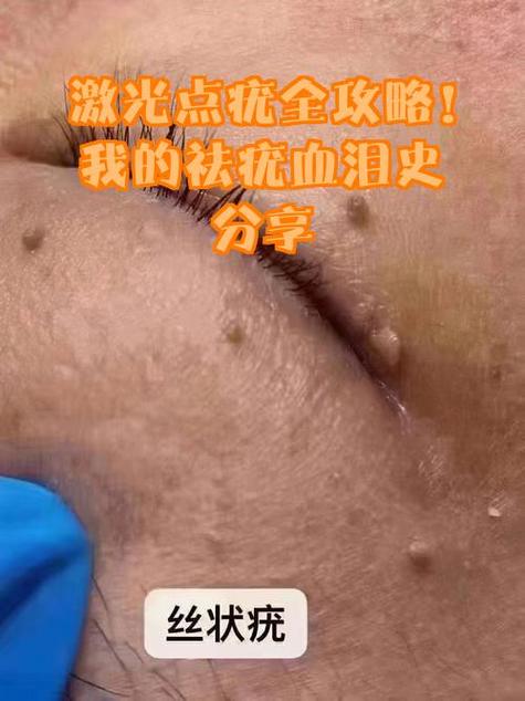 激光打瘊子多少钱一个