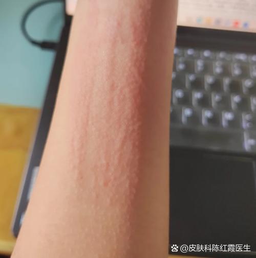 戴手链过敏起小疙瘩