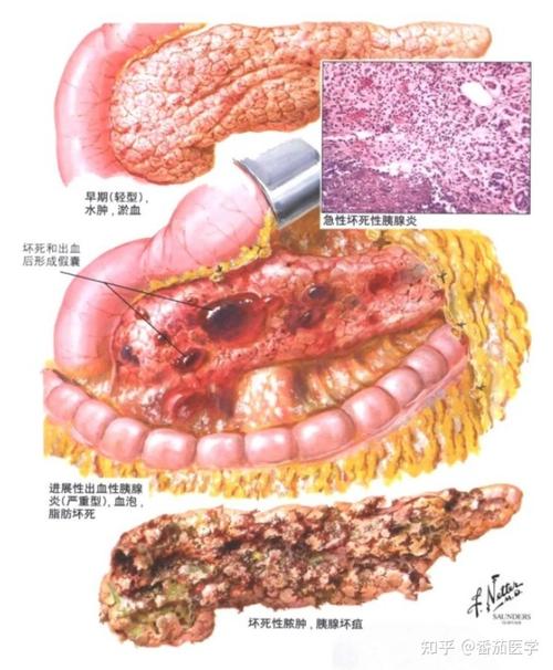 胰腺炎是纵欲过度引起的吗