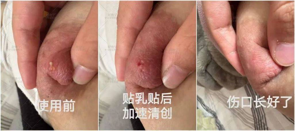 堵奶小白点怎么挤出来