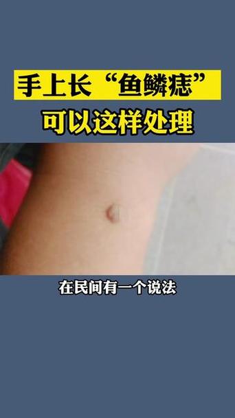 鱼鳞痣怎么去除