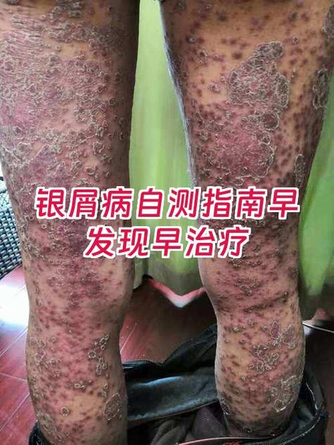 银屑病怎么根治图标
