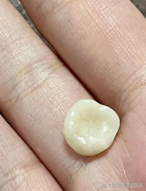 牙齿碎了一半要拔掉吗缩略图
