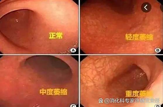 做胃镜会感染艾滋病吗
