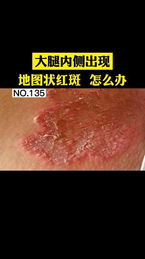 大腿根内测红斑