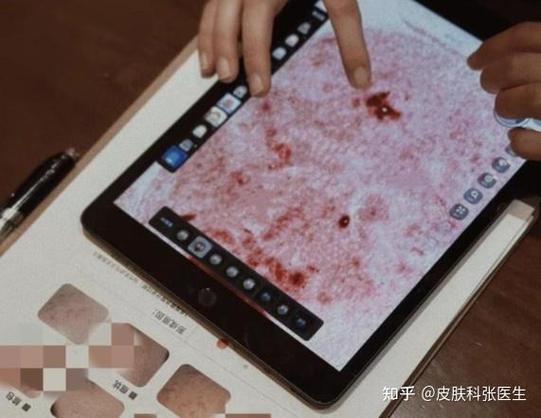 背上长小黑点的原因和解决方法