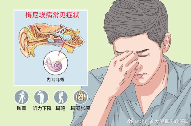 美尼尔眩晕症和梅尼埃区别