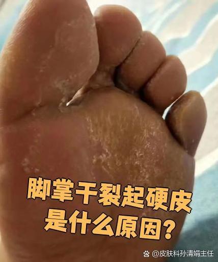脚底裂开了一个深口子怎么办
