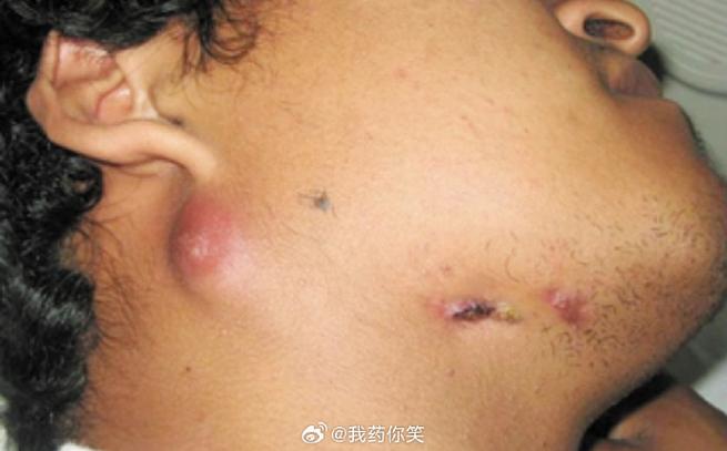 脖子下面淋巴结肿大