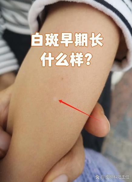 身上开始长白点怎么回事