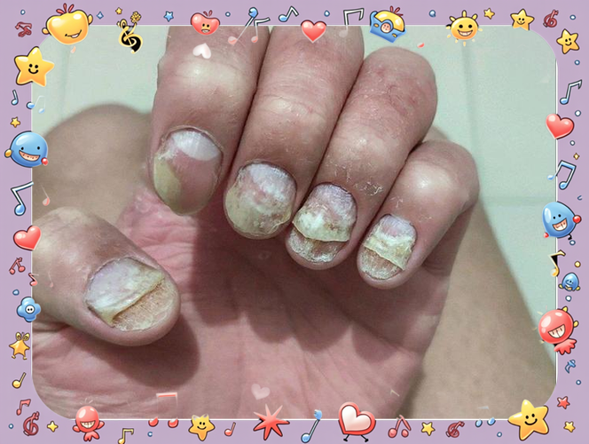 畸形指甲