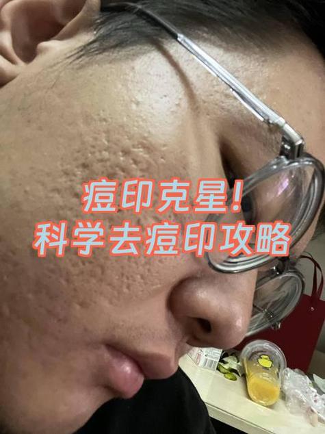 什么方法去痘印快
