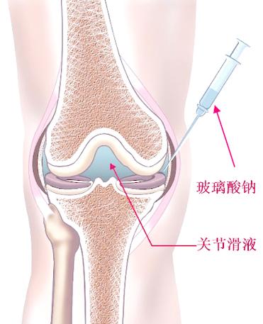 膝盖痛可以打玻璃酸钠吗