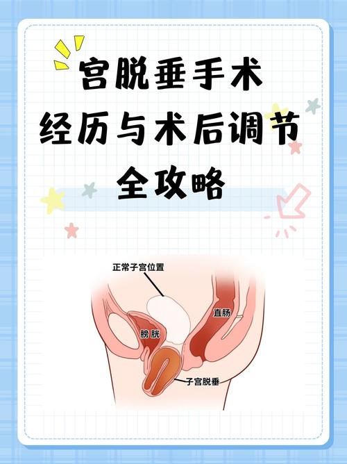 子宫脱垂手术大夫排名