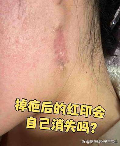请问伤疤留下来印记怎么消除