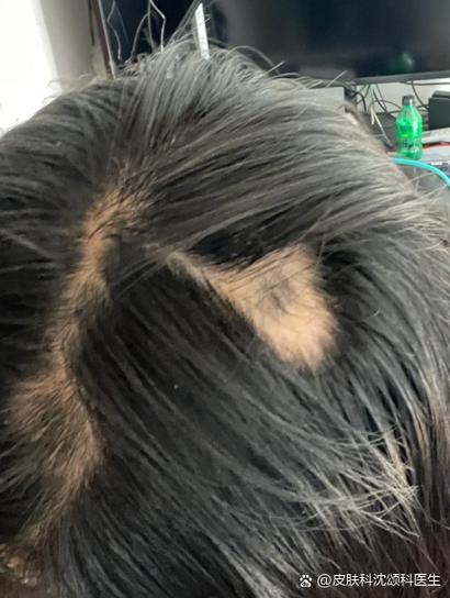 头顶脱发后长出的小绒毛能长粗?
