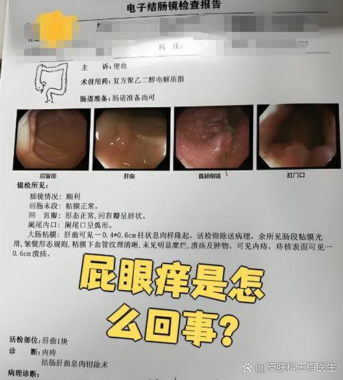 肛门瘙痒是怎么回事女性图标