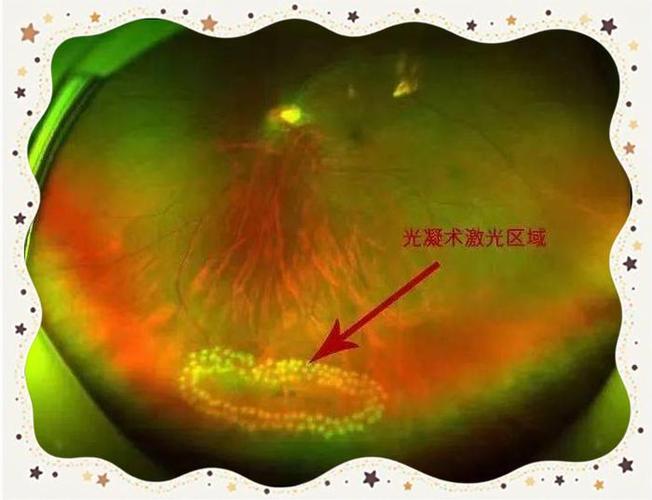 光凝术当天能做吗