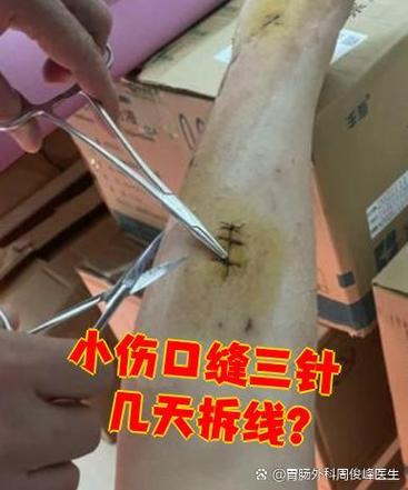 缝三针拆线需要几分钟