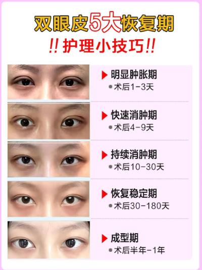 开眼角15天恢复图
