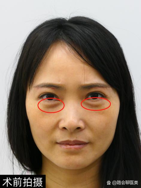 做了眼袋手术眼睛凹陷显老怎么办