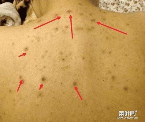螨虫皮炎的图片