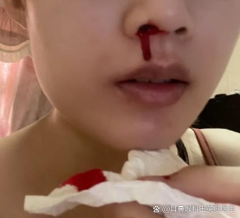 喝酒流鼻血危险吗缩略图