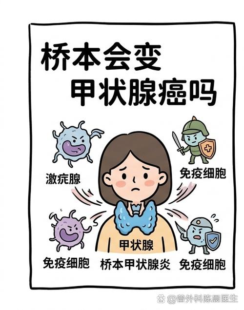 甲状腺癌合并桥本要全切吗